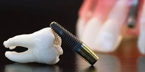 Implantologia Milano