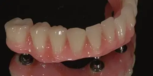 Implantologia Milano