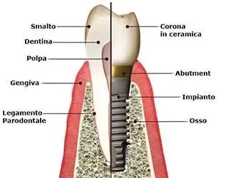 Implantologia Milano